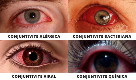 O que é e quais os tipos de conjuntivite?